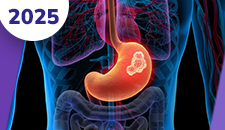 Carcinomas neuroendócrinos extrapulmonares