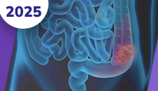 Cólon: doença avançada