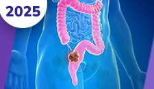 Cólon: doença localizada